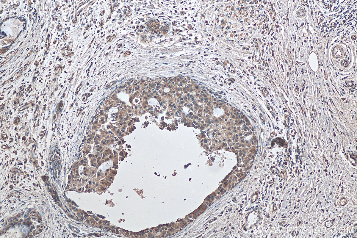 IHC staining of human breast cancer using 67250-1-Ig