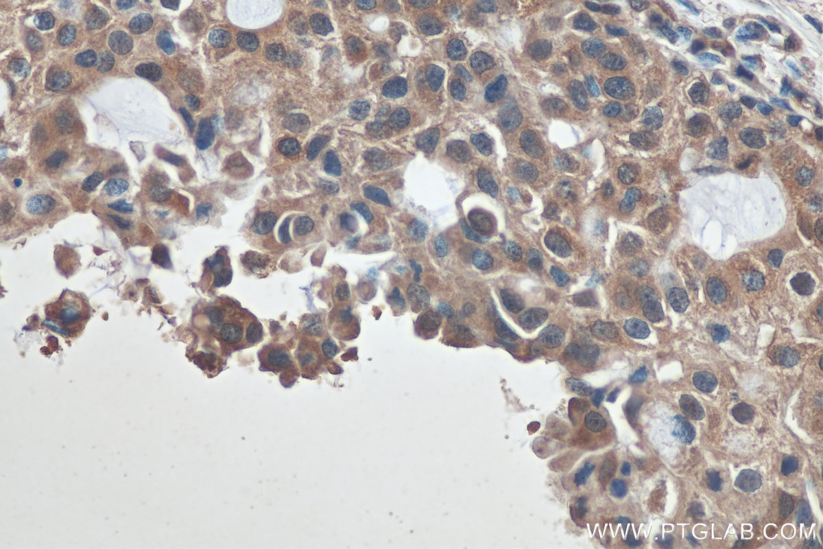 Immunohistochemistry (IHC) staining of human breast cancer tissue using HDAC6 Monoclonal antibody (67250-1-Ig)