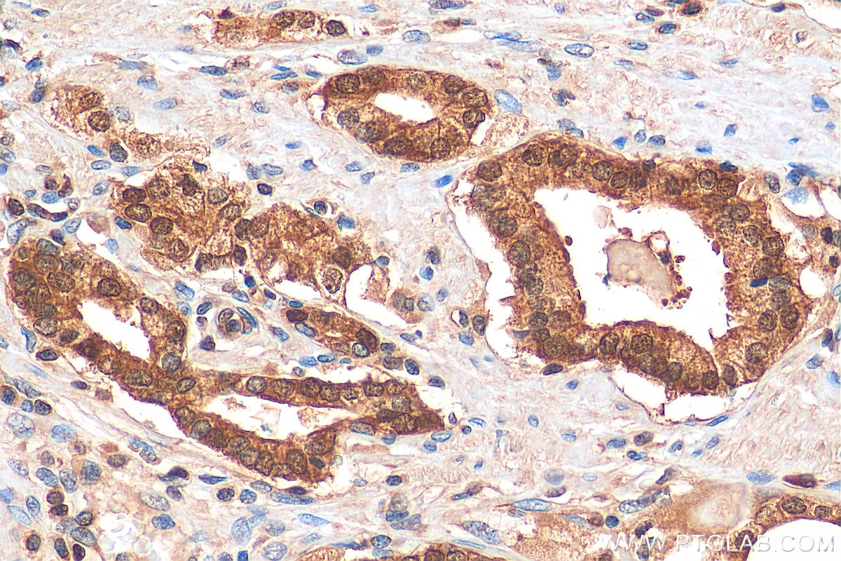 Immunohistochemistry (IHC) staining of human prostate cancer tissue using HDDC3 Polyclonal antibody (21091-1-AP)