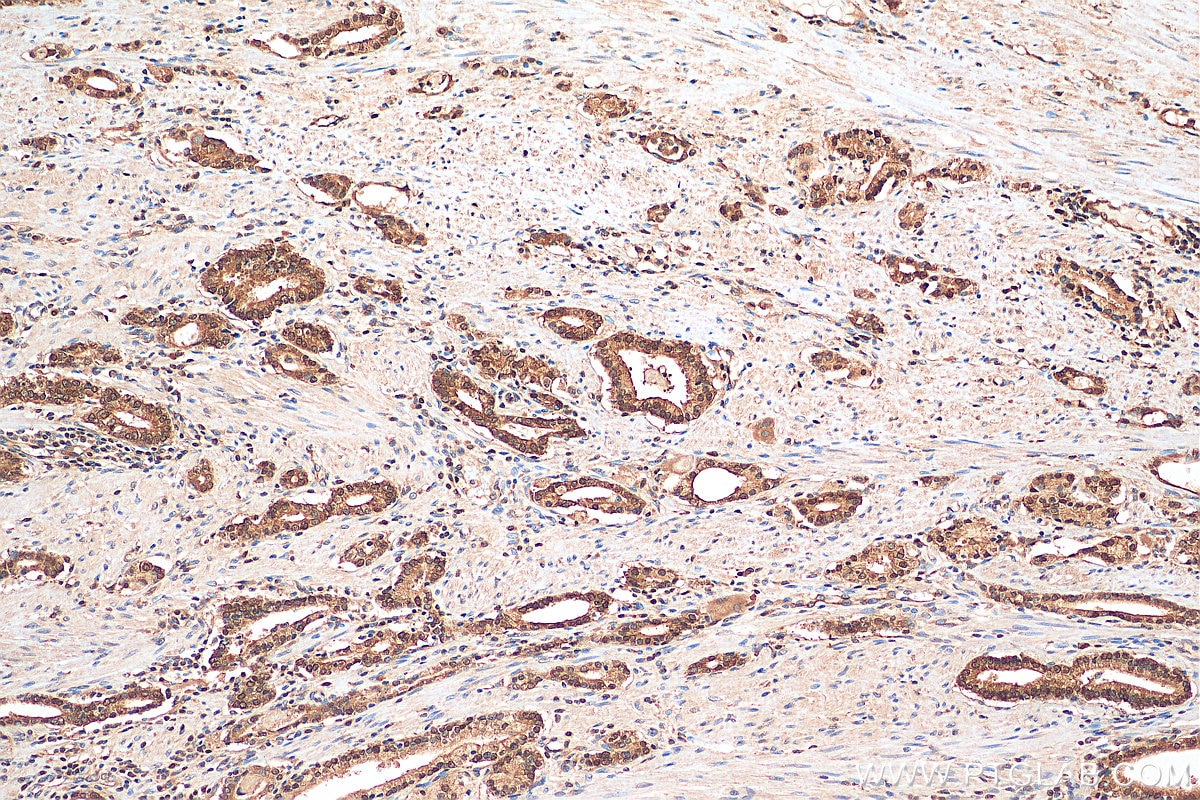 Immunohistochemistry (IHC) staining of human prostate cancer tissue using HDDC3 Polyclonal antibody (21091-1-AP)