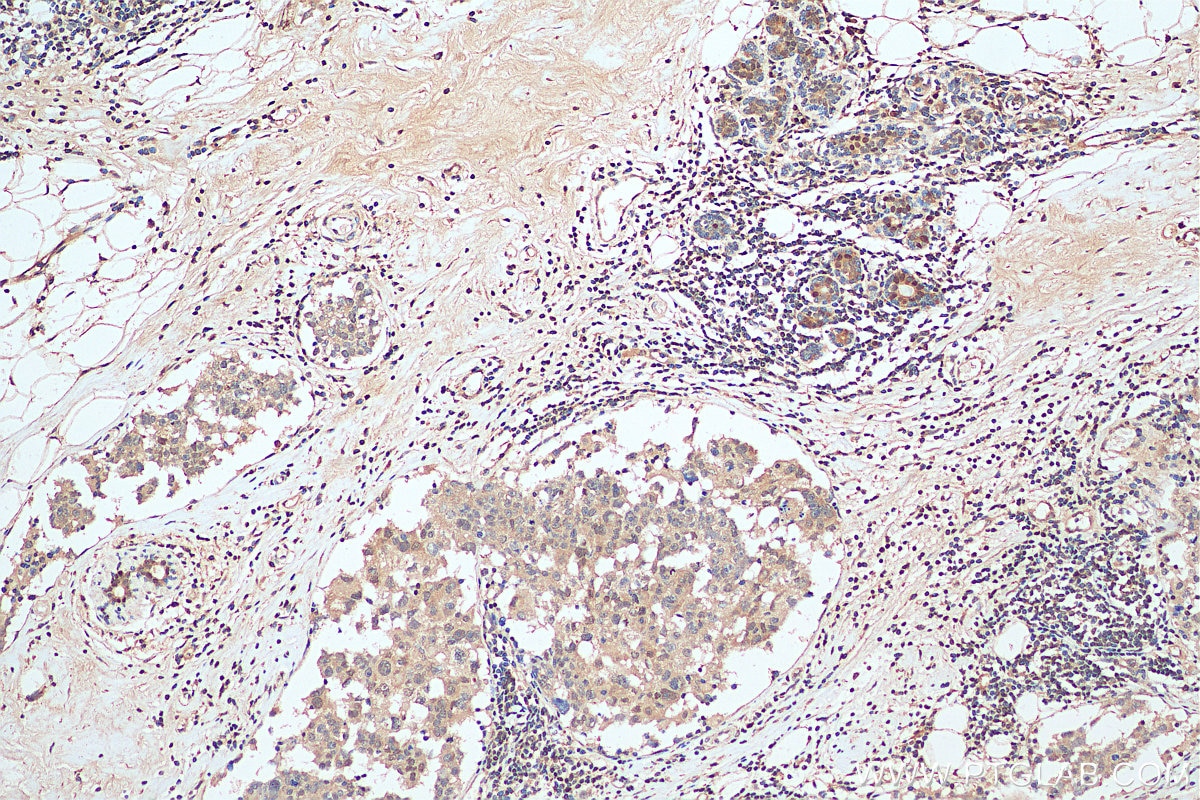 Immunohistochemistry (IHC) staining of human breast cancer tissue using HDDC3 Polyclonal antibody (21091-1-AP)