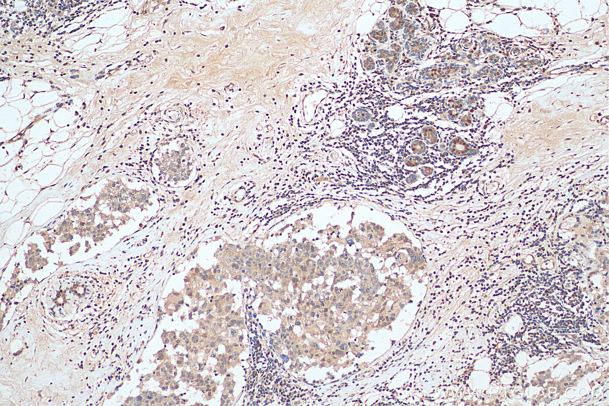 IHC staining of human breast cancer using 21091-1-AP