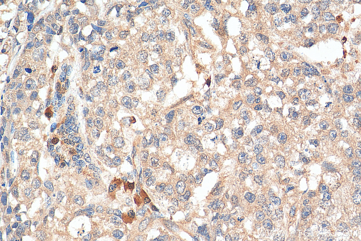 IHC staining of human breast cancer using 21091-1-AP
