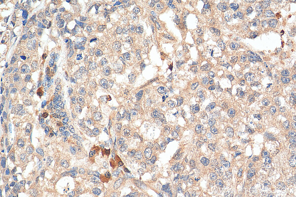 Immunohistochemistry (IHC) staining of human breast cancer tissue using HDDC3 Polyclonal antibody (21091-1-AP)