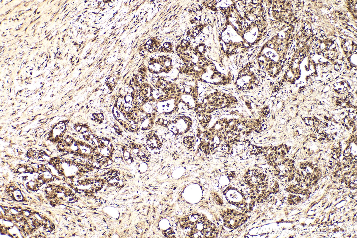 Immunohistochemistry (IHC) staining of human colon cancer tissue using HDGF Polyclonal antibody (11344-1-AP)
