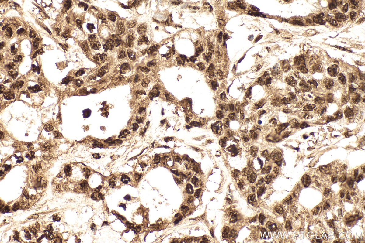 Immunohistochemistry (IHC) staining of human colon cancer tissue using HDGF Polyclonal antibody (11344-1-AP)