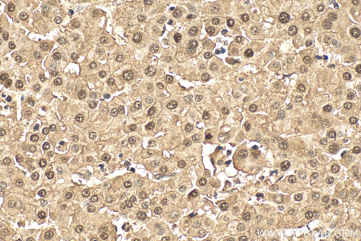 Immunohistochemistry (IHC) staining of human liver cancer tissue using HDGF Polyclonal antibody (11344-1-AP)
