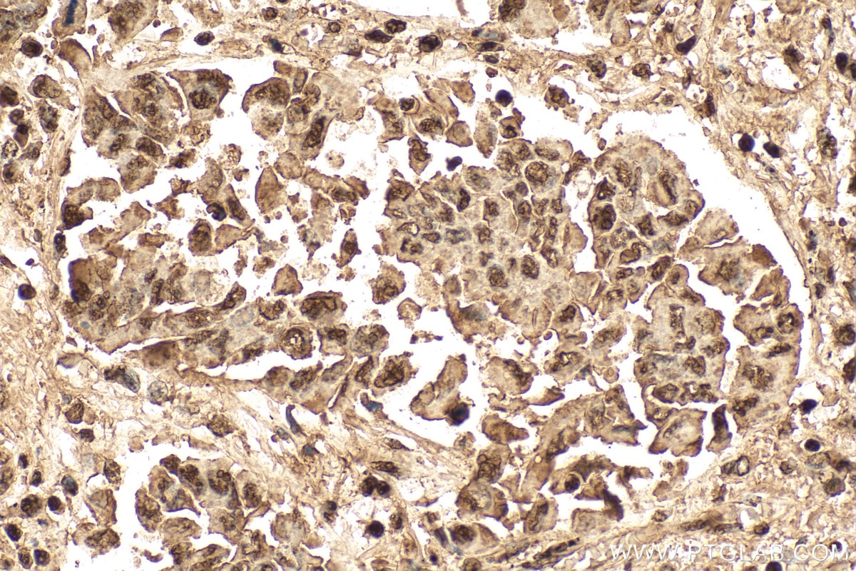 Immunohistochemistry (IHC) staining of human lung cancer tissue using HDGF Polyclonal antibody (11344-1-AP)