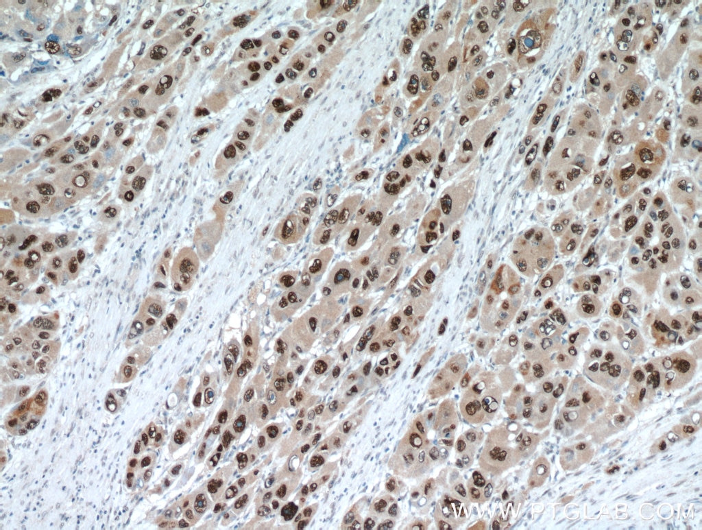 Immunohistochemistry (IHC) staining of human liver cancer tissue using HDGF Polyclonal antibody (11344-1-AP)
