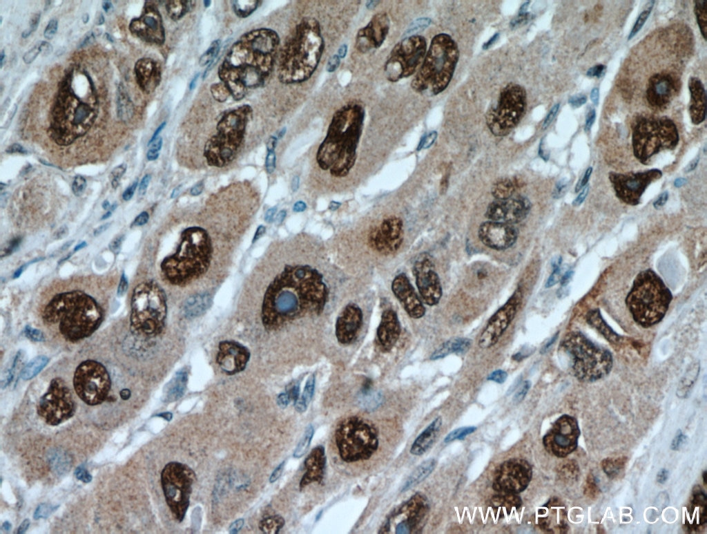 Immunohistochemistry (IHC) staining of human liver cancer tissue using HDGF Polyclonal antibody (11344-1-AP)