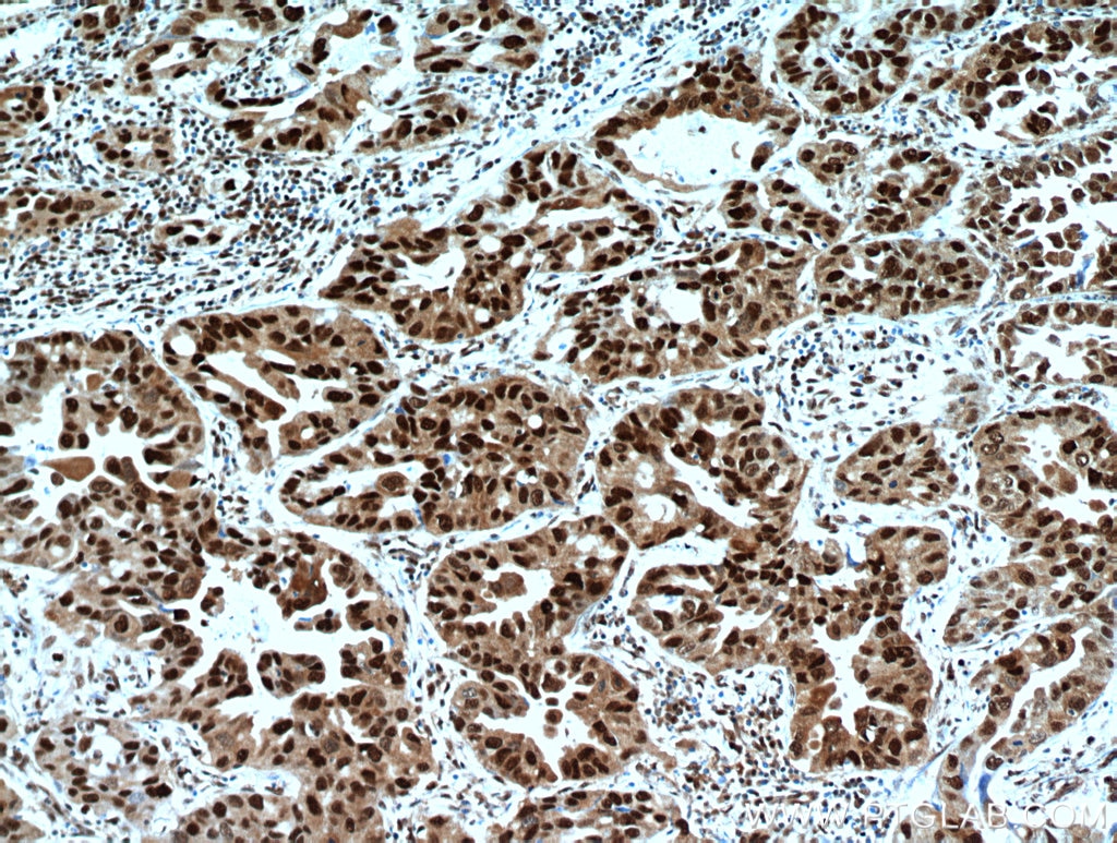 Immunohistochemistry (IHC) staining of human lung cancer tissue using HDGF Polyclonal antibody (11344-1-AP)