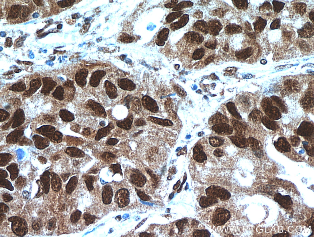 Immunohistochemistry (IHC) staining of human lung cancer tissue using HDGF Polyclonal antibody (11344-1-AP)