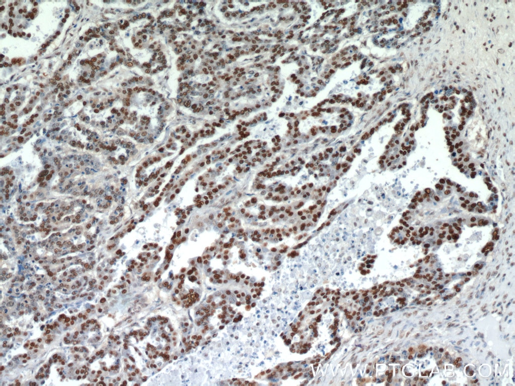 Immunohistochemistry (IHC) staining of human ovary tumor tissue using HDGF Polyclonal antibody (11344-1-AP)
