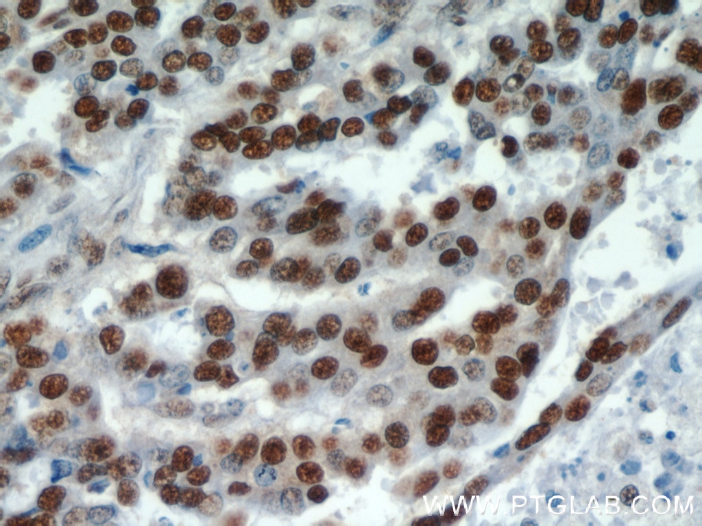 Immunohistochemistry (IHC) staining of human ovary tumor tissue using HDGF Polyclonal antibody (11344-1-AP)