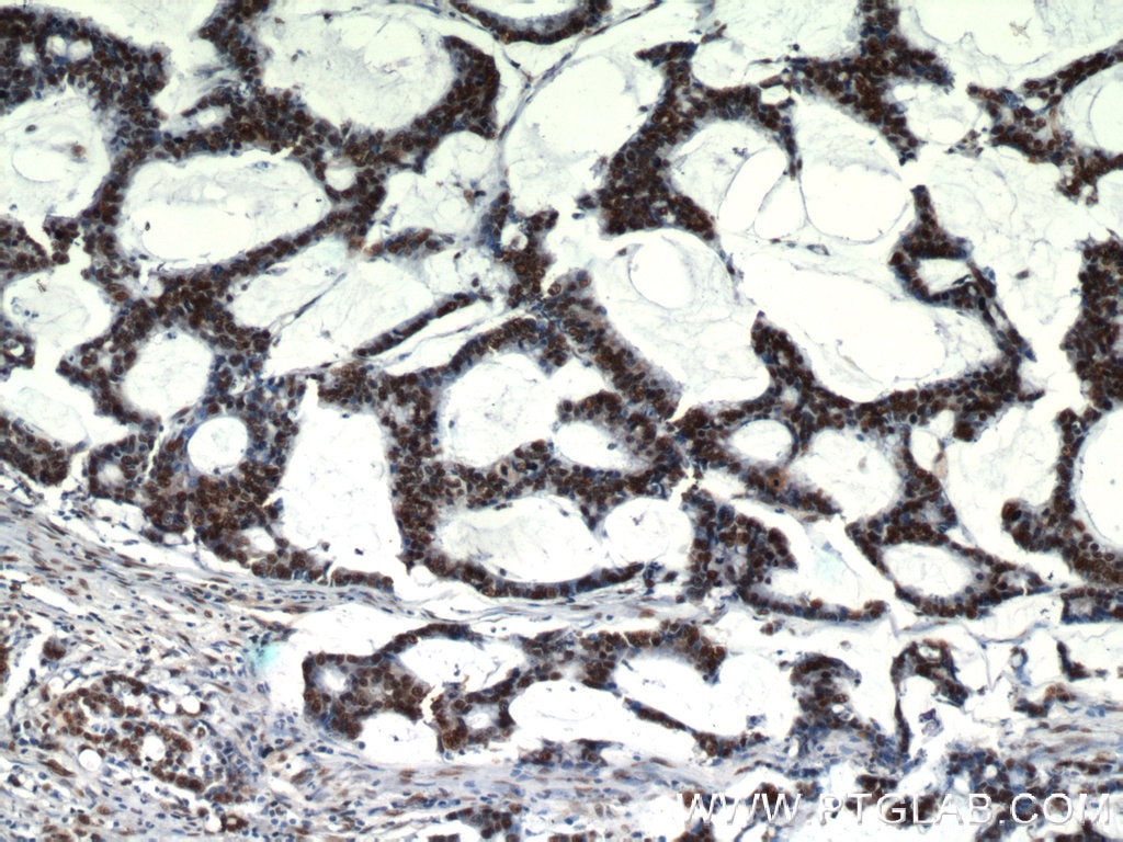 Immunohistochemistry (IHC) staining of human colon cancer tissue using HDGF Polyclonal antibody (11344-1-AP)