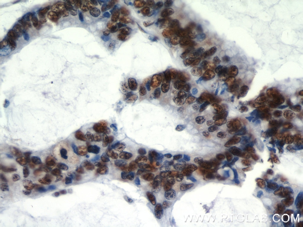 Immunohistochemistry (IHC) staining of human colon cancer tissue using HDGF Polyclonal antibody (11344-1-AP)