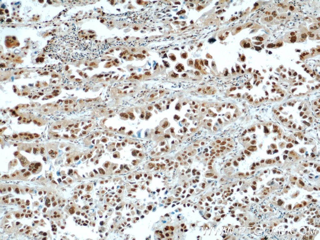 Immunohistochemistry (IHC) staining of human lung cancer tissue using HDGF Polyclonal antibody (11344-1-AP)