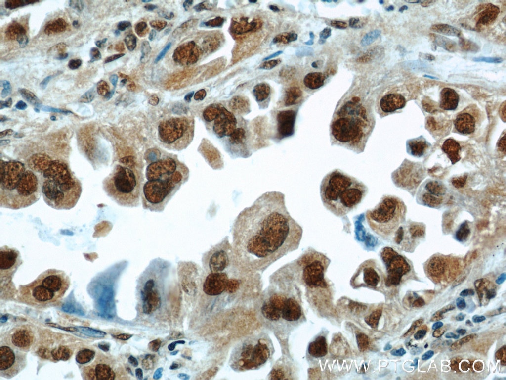 Immunohistochemistry (IHC) staining of human lung cancer tissue using HDGF Polyclonal antibody (11344-1-AP)