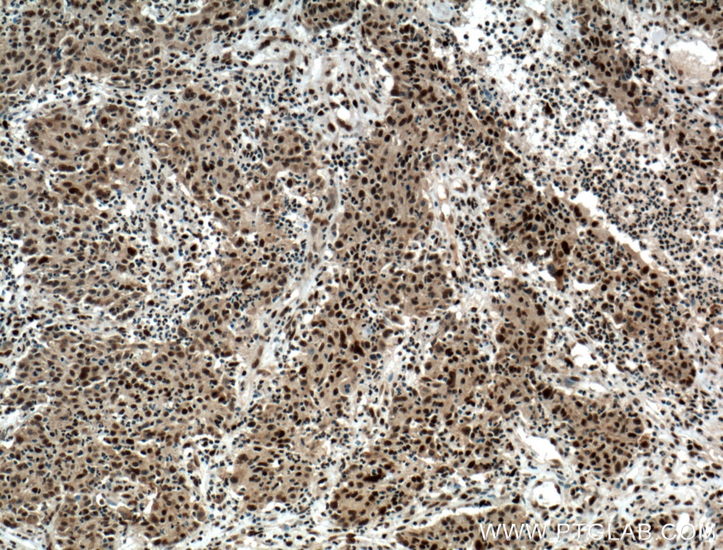 Immunohistochemistry (IHC) staining of human colon cancer tissue using HDGF Monoclonal antibody (60064-1-Ig)