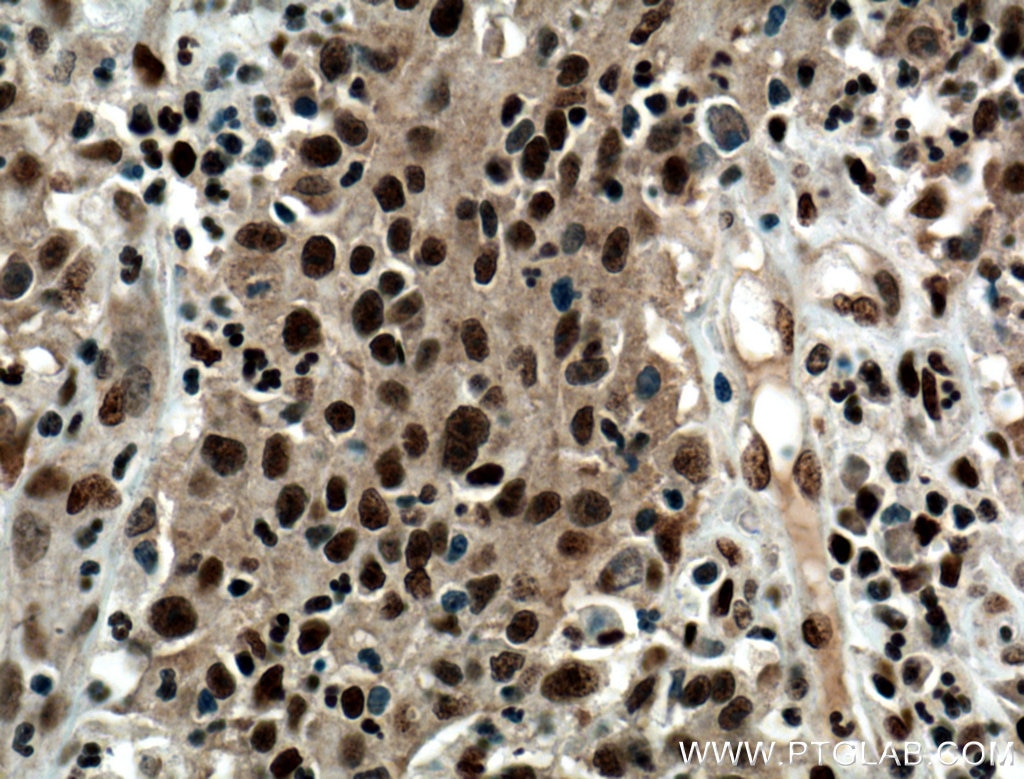 Immunohistochemistry (IHC) staining of human colon cancer tissue using HDGF Monoclonal antibody (60064-1-Ig)