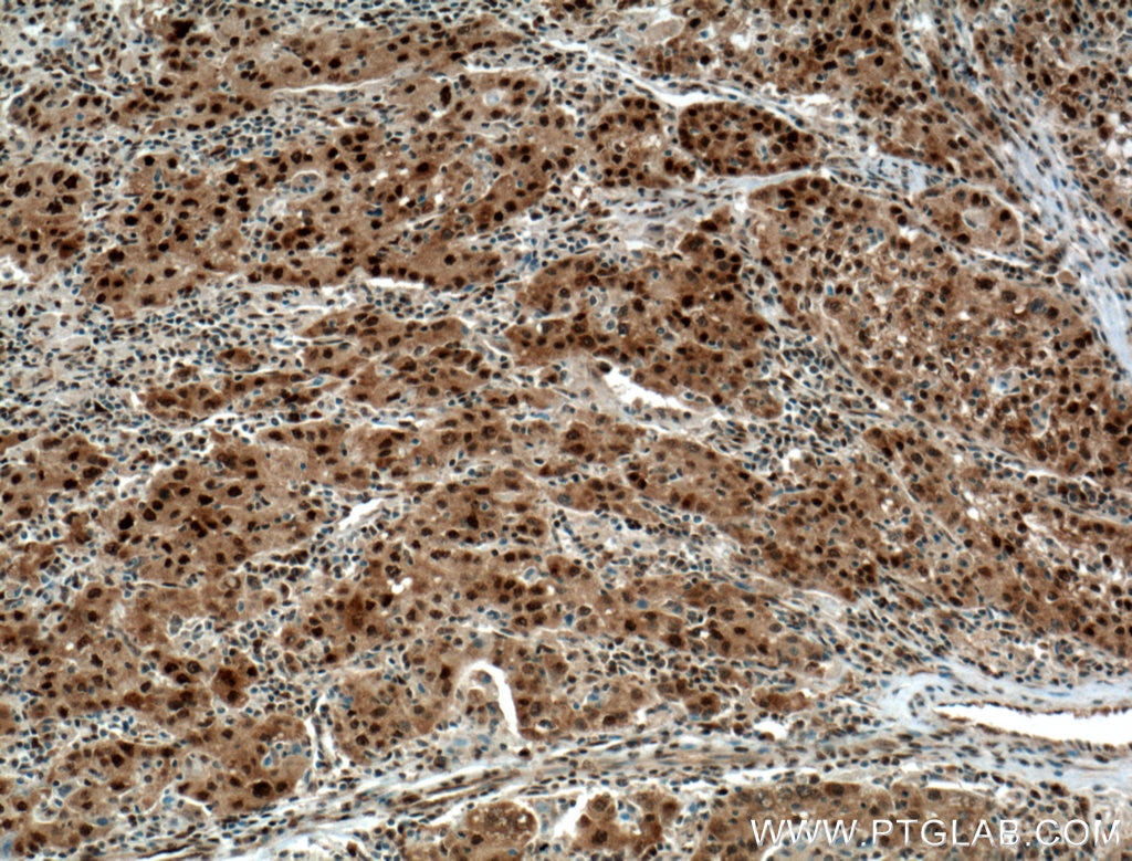 Immunohistochemistry (IHC) staining of human liver cancer tissue using HDGF Monoclonal antibody (60064-1-Ig)