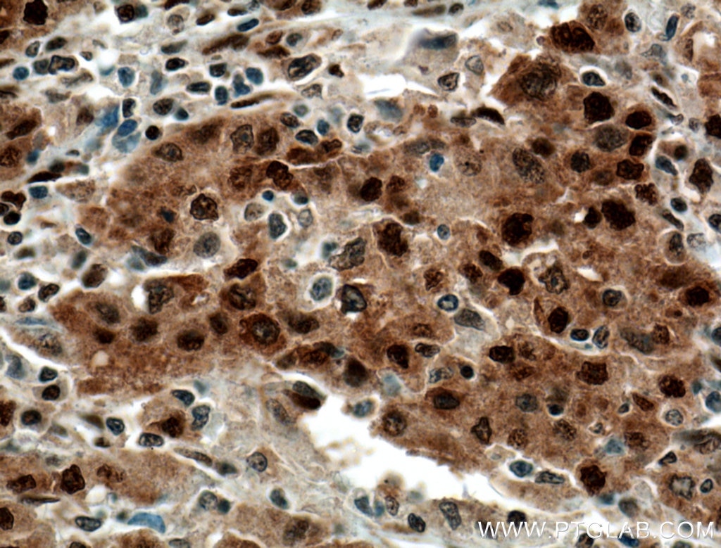 Immunohistochemistry (IHC) staining of human liver cancer tissue using HDGF Monoclonal antibody (60064-1-Ig)
