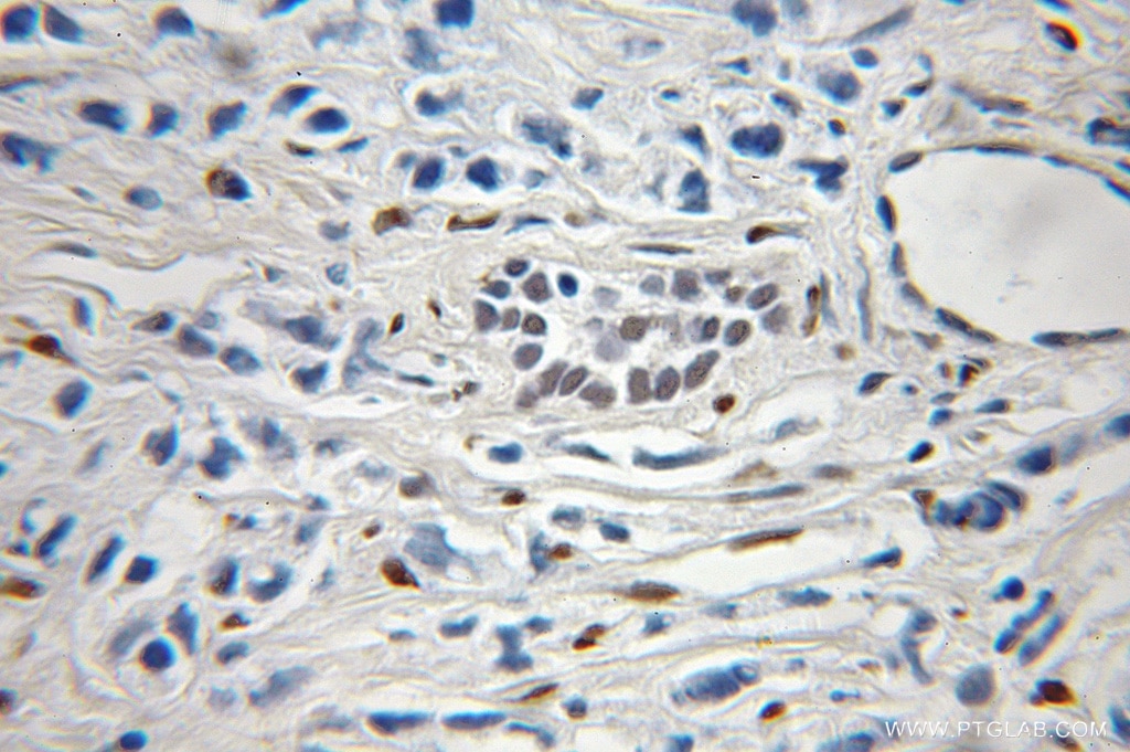 Immunohistochemistry (IHC) staining of human prostate cancer tissue using HDGFRP3 Polyclonal antibody (12380-1-AP)