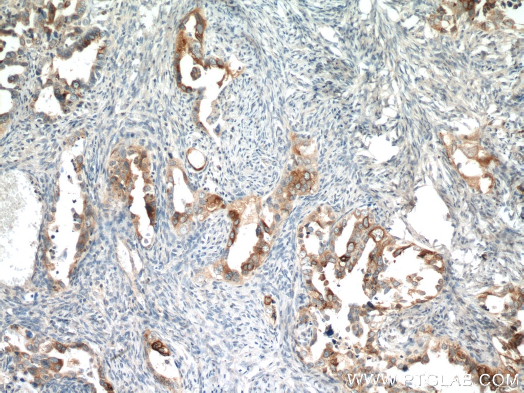 Immunohistochemistry (IHC) staining of human ovary tumor tissue using HE4 Monoclonal antibody (66557-1-Ig)