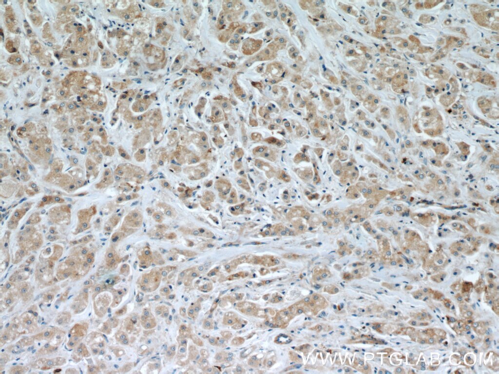 Immunohistochemistry (IHC) staining of human breast cancer tissue using HEATR4 Polyclonal antibody (23944-1-AP)
