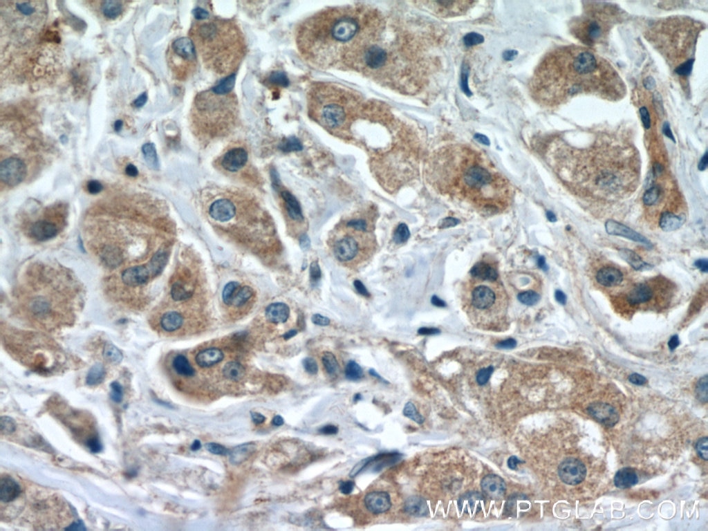 Immunohistochemistry (IHC) staining of human breast cancer tissue using HEATR4 Polyclonal antibody (23944-1-AP)
