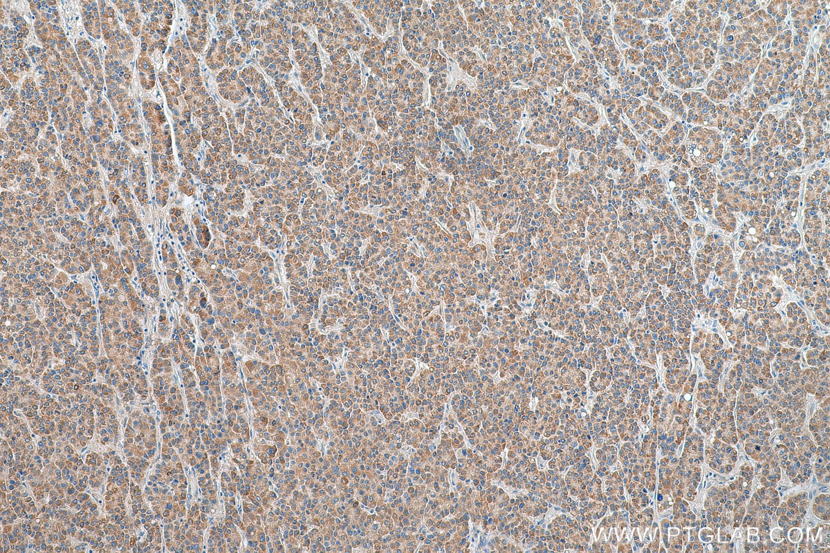 Immunohistochemistry (IHC) staining of human liver cancer tissue using HEBP1 Polyclonal antibody (16842-1-AP)