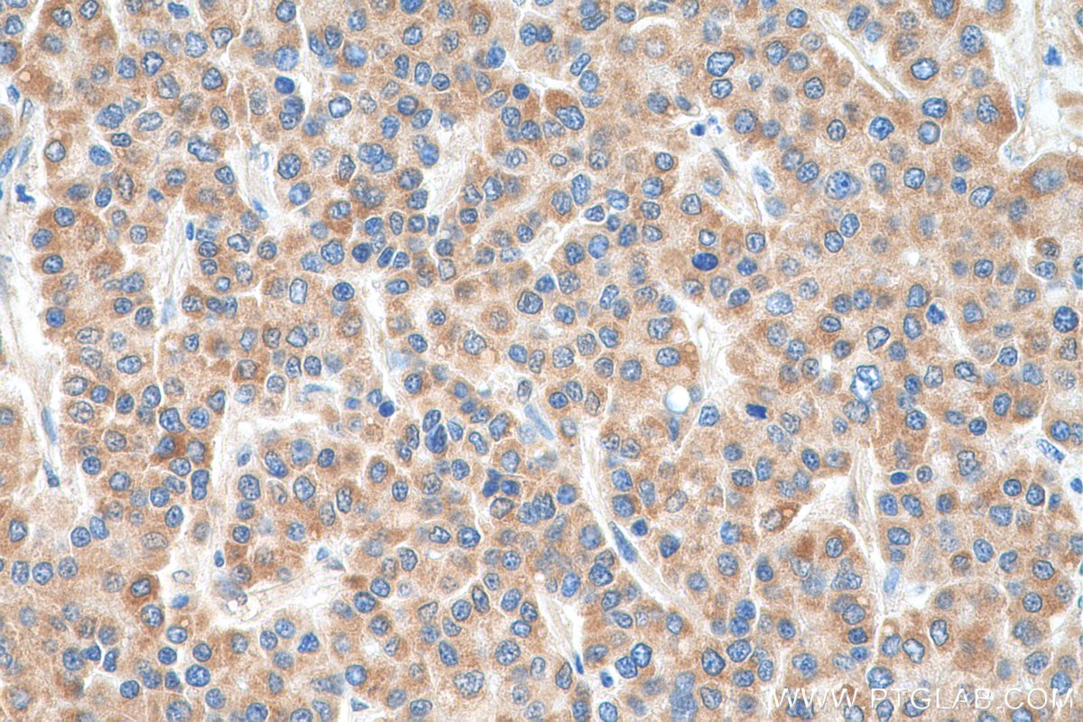 Immunohistochemistry (IHC) staining of human liver cancer tissue using HEBP1 Polyclonal antibody (16842-1-AP)