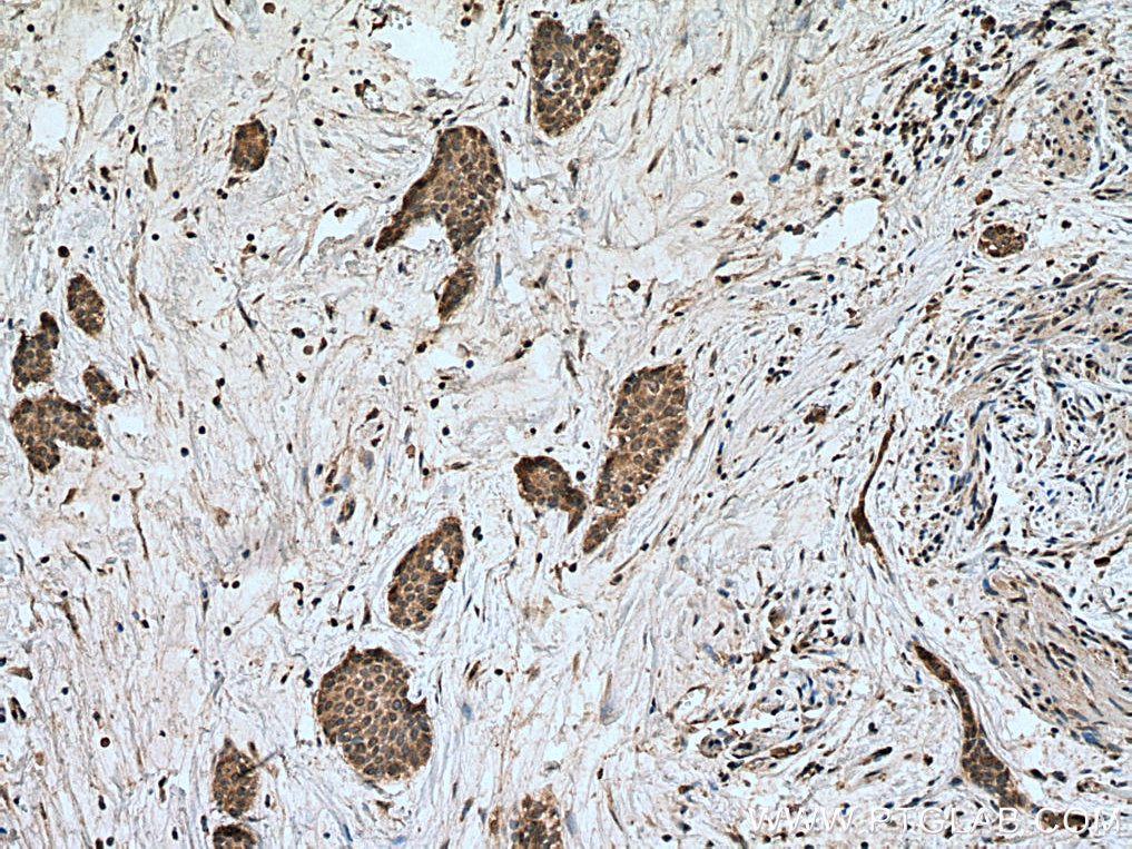 Immunohistochemistry (IHC) staining of human urothelial carcinoma tissue using HECW1 Polyclonal antibody (24695-1-AP)
