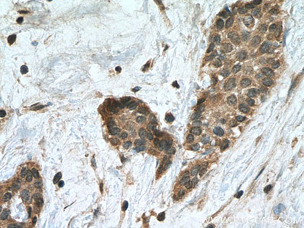Immunohistochemistry (IHC) staining of human urothelial carcinoma tissue using HECW1 Polyclonal antibody (24695-1-AP)