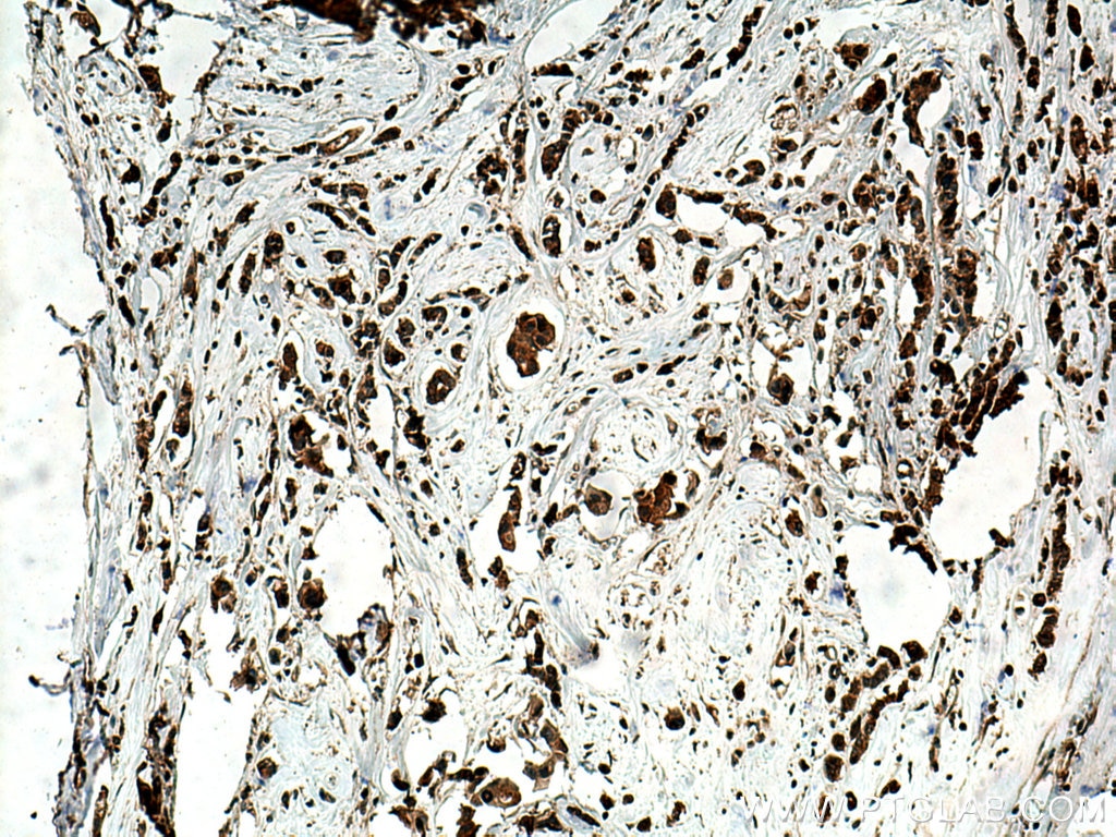 Immunohistochemistry (IHC) staining of human breast cancer tissue using HELZ Polyclonal antibody (26635-1-AP)