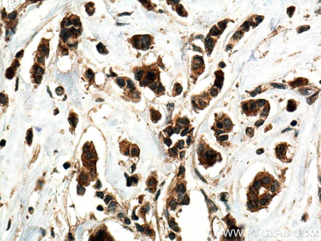 Immunohistochemistry (IHC) staining of human breast cancer tissue using HELZ Polyclonal antibody (26635-1-AP)