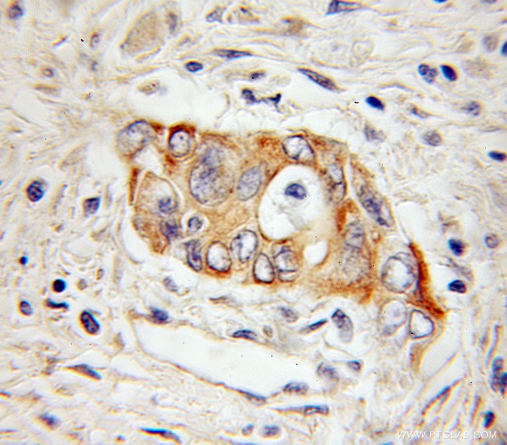 Immunohistochemistry (IHC) staining of human pancreas cancer tissue using Hephaestin Polyclonal antibody (11148-1-AP)