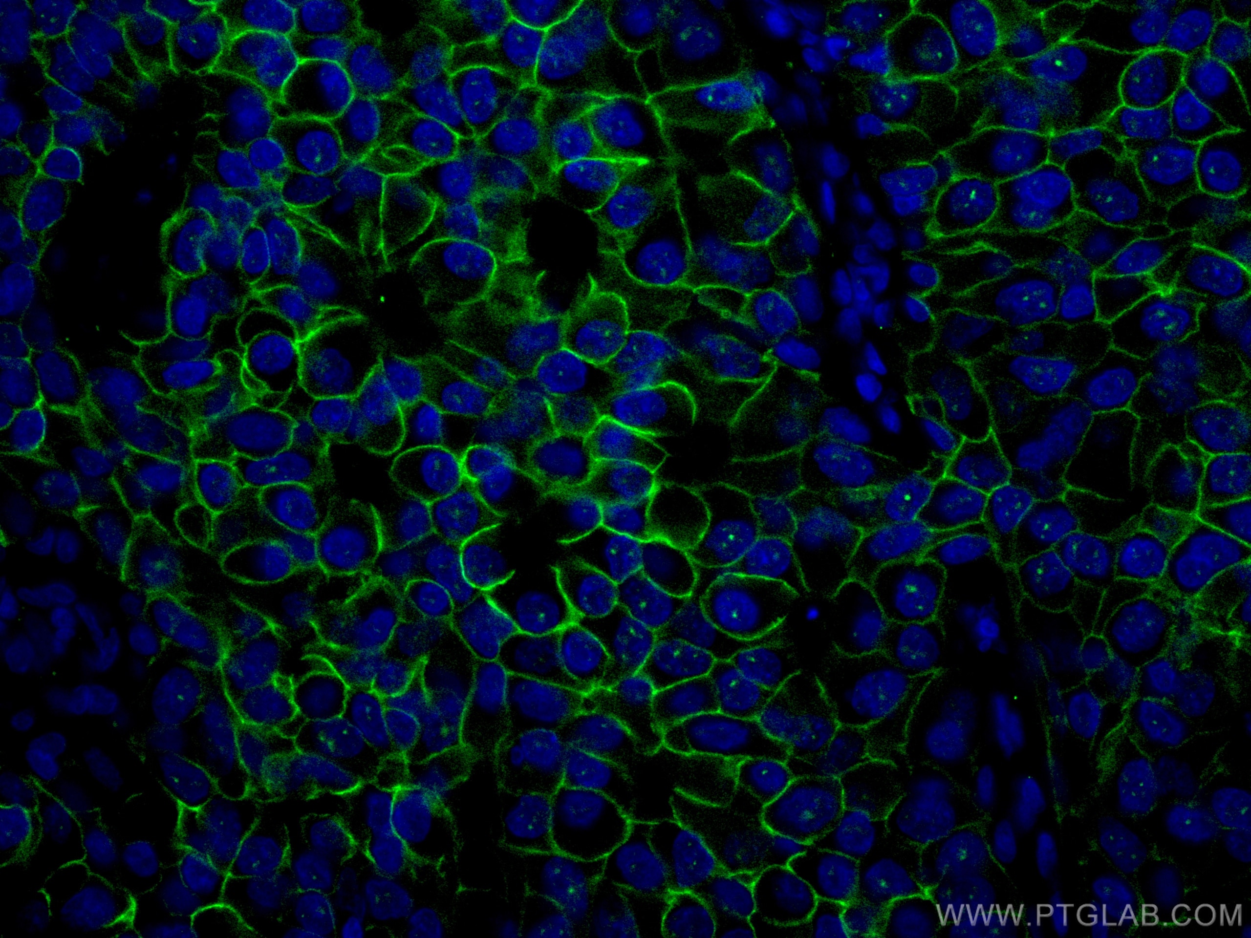 IF Staining of human breast cancer using CL488-60311