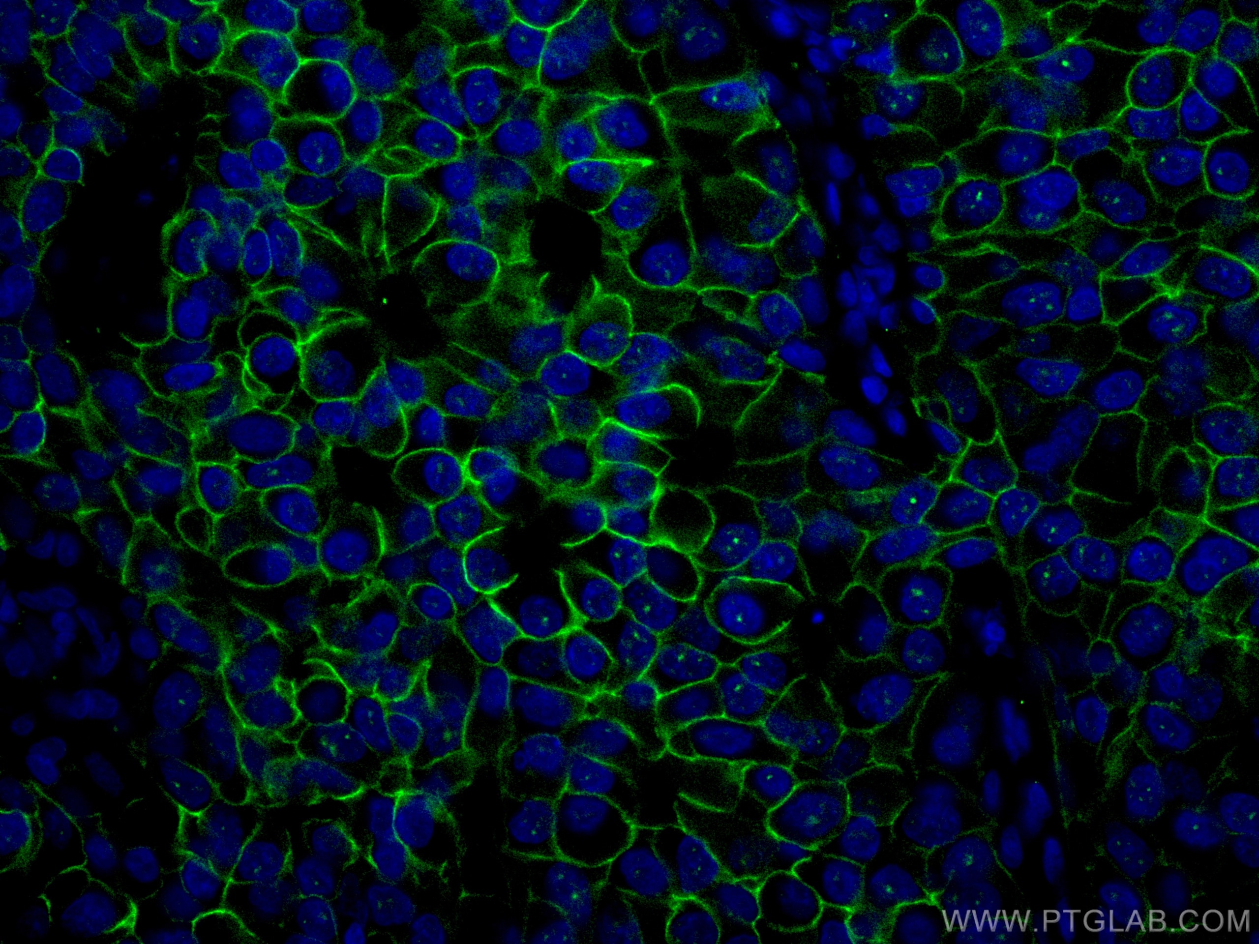 Immunofluorescence (IF) / fluorescent staining of human breast cancer tissue using CoraLite® Plus 488-conjugated HER2/ErbB2 Monoclona (CL488-60311)