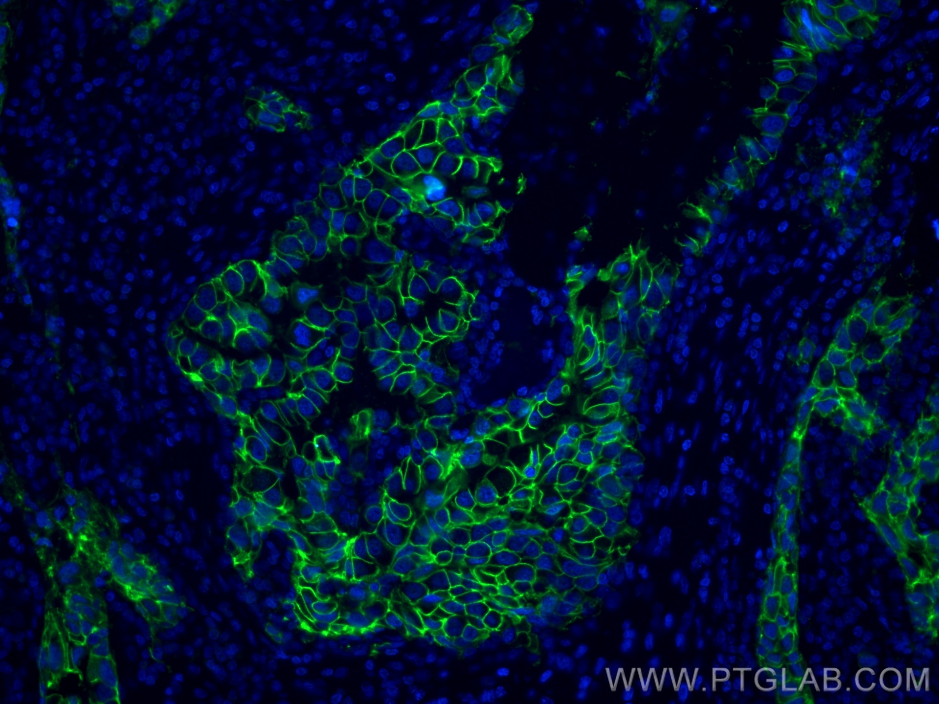 Immunofluorescence (IF) / fluorescent staining of human breast cancer tissue using CoraLite® Plus 488-conjugated HER2/ErbB2 Monoclona (CL488-60311)