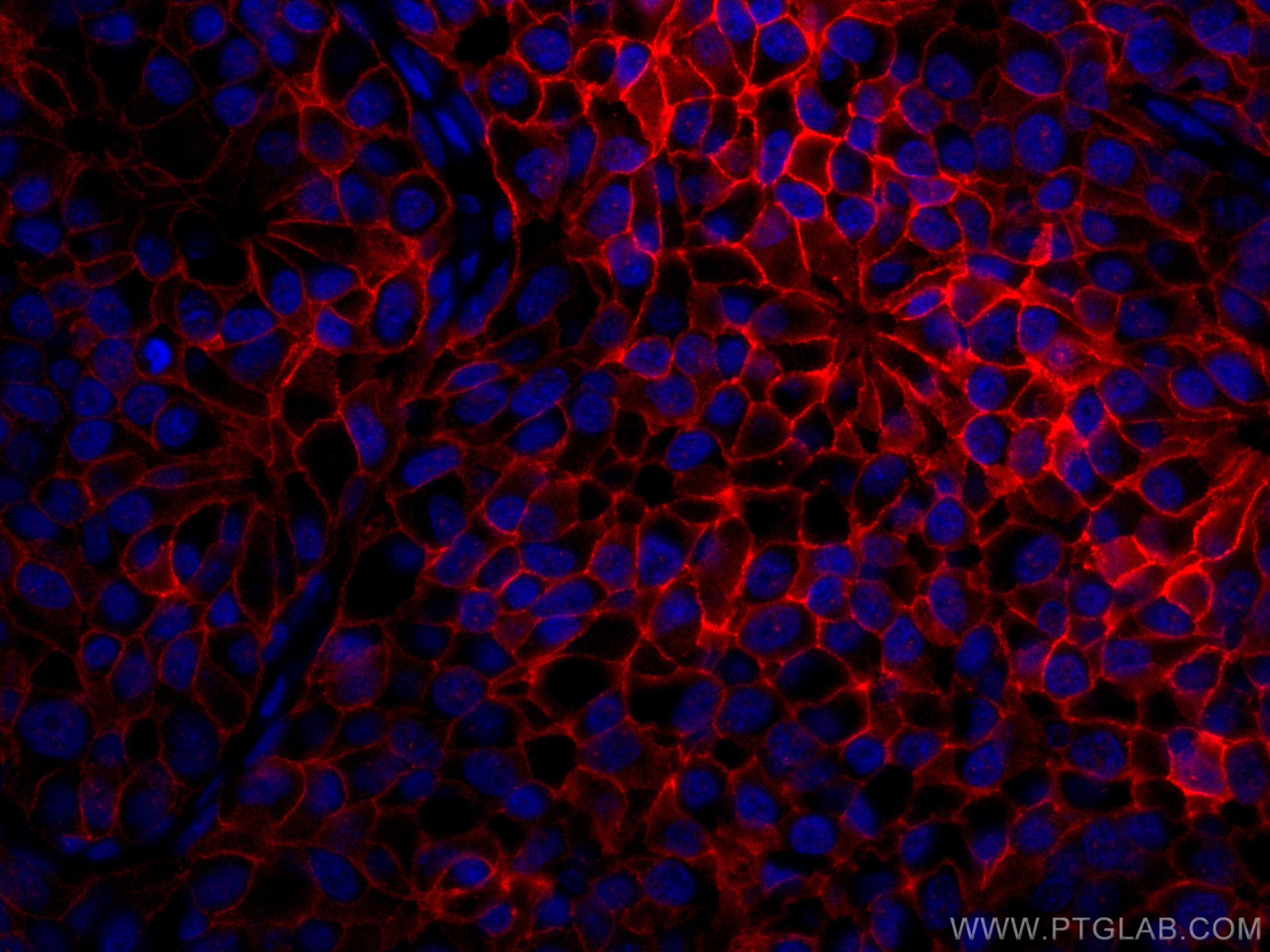 Immunofluorescence (IF) / fluorescent staining of human breast cancer tissue using CoraLite®594-conjugated HER2/ErbB2 Monoclonal anti (CL594-60311)