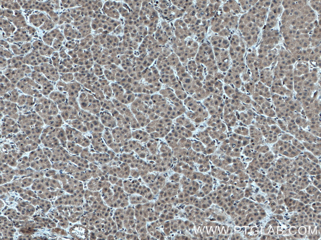 Immunohistochemistry (IHC) staining of human liver cancer tissue using HERC2 Polyclonal antibody (27459-1-AP)