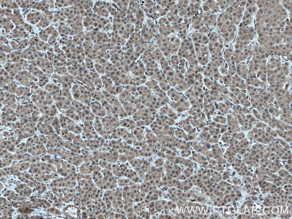 Immunohistochemistry (IHC) staining of human liver cancer tissue using HERC2 Polyclonal antibody (27459-1-AP)