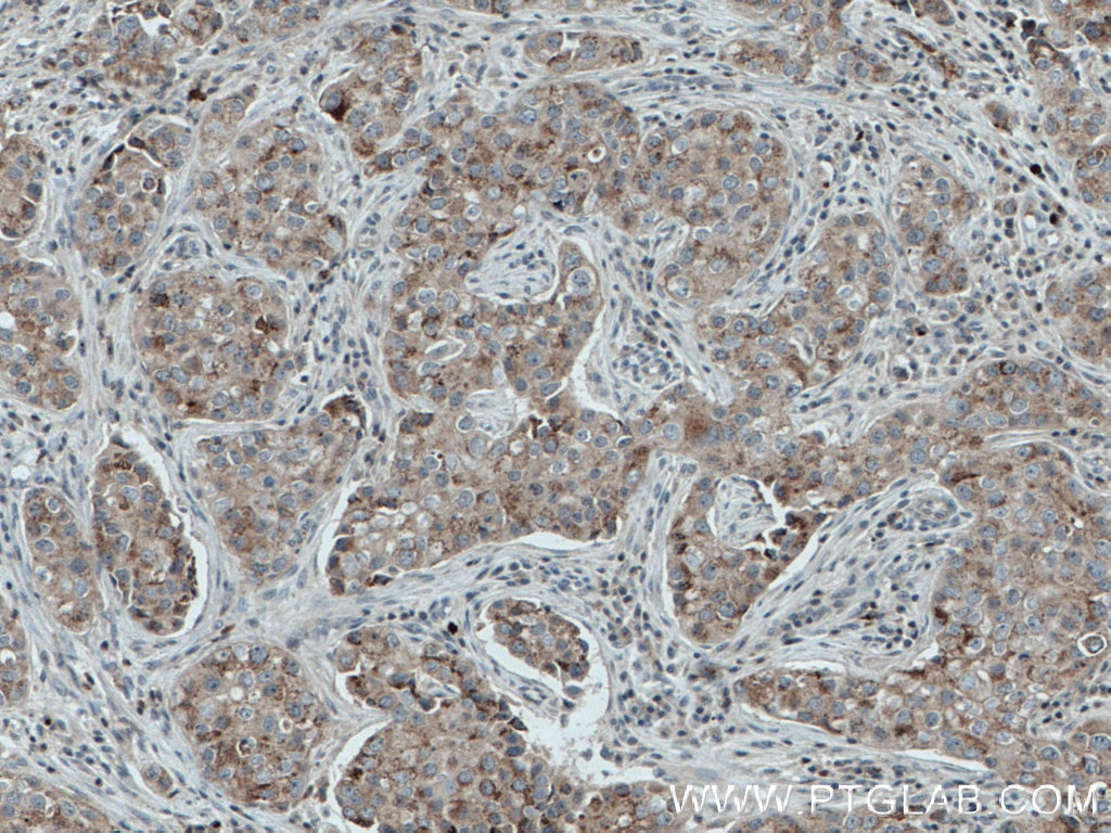 Immunohistochemistry (IHC) staining of human breast cancer tissue using HERC2 Polyclonal antibody (27459-1-AP)