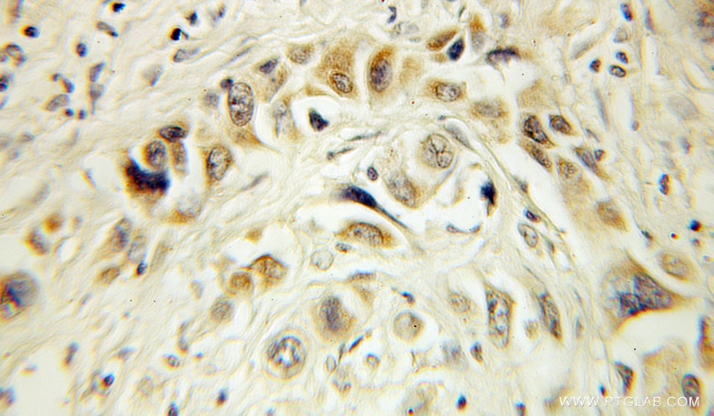 Immunohistochemistry (IHC) staining of human lung cancer tissue using HERP Polyclonal antibody (10813-1-AP)