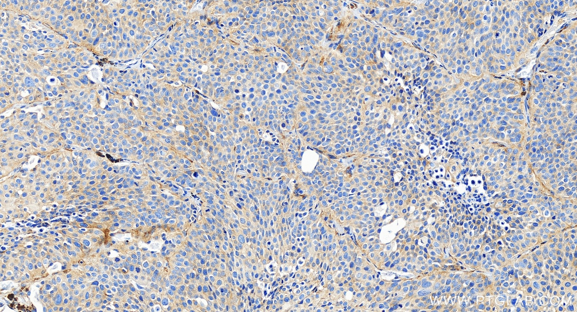 Immunohistochemistry (IHC) staining of human lung cancer tissue using HERPUD1 Recombinant antibody (85627-1-RR)