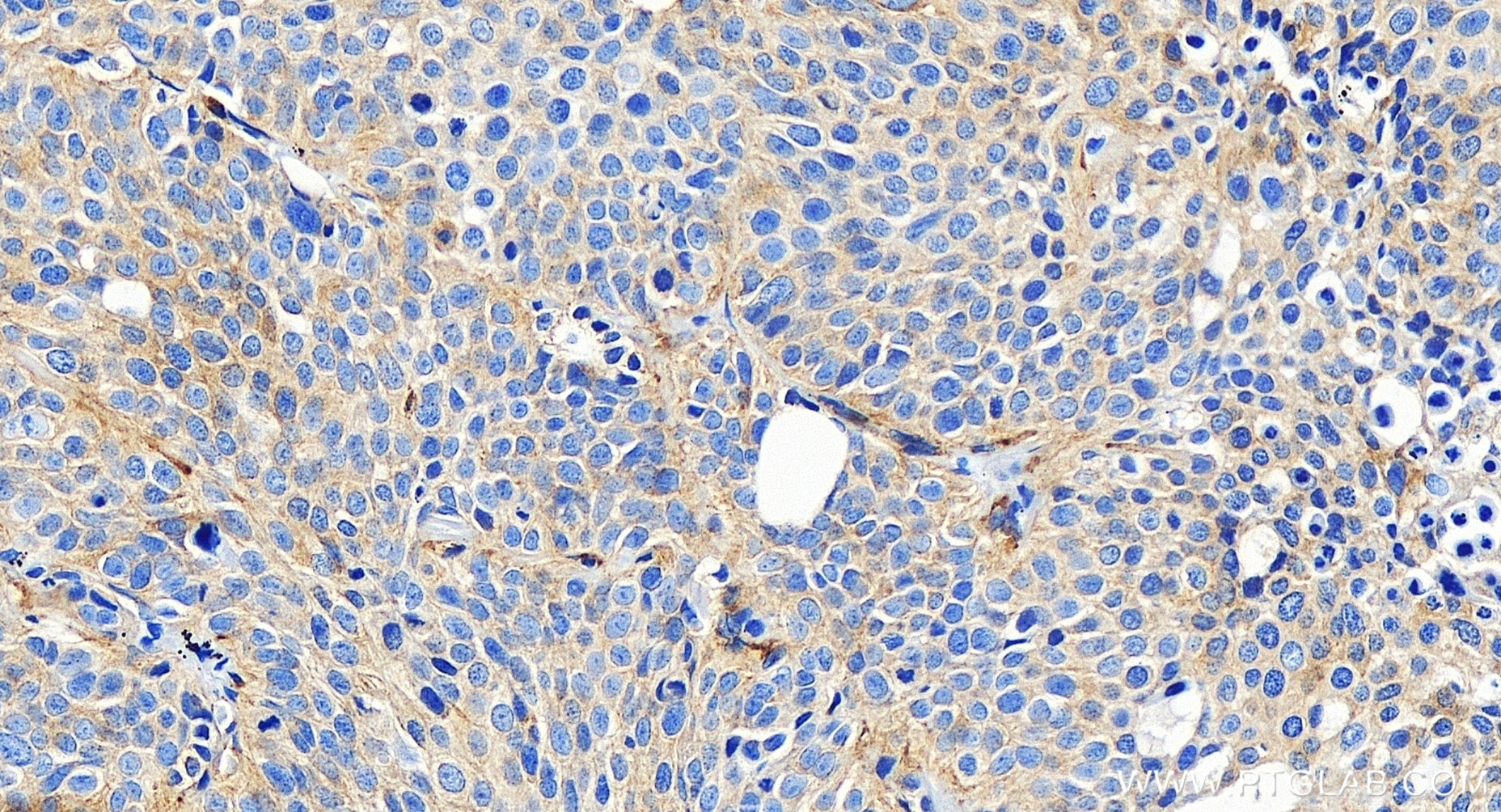 Immunohistochemistry (IHC) staining of human lung cancer tissue using HERPUD1 Recombinant antibody (85627-1-RR)