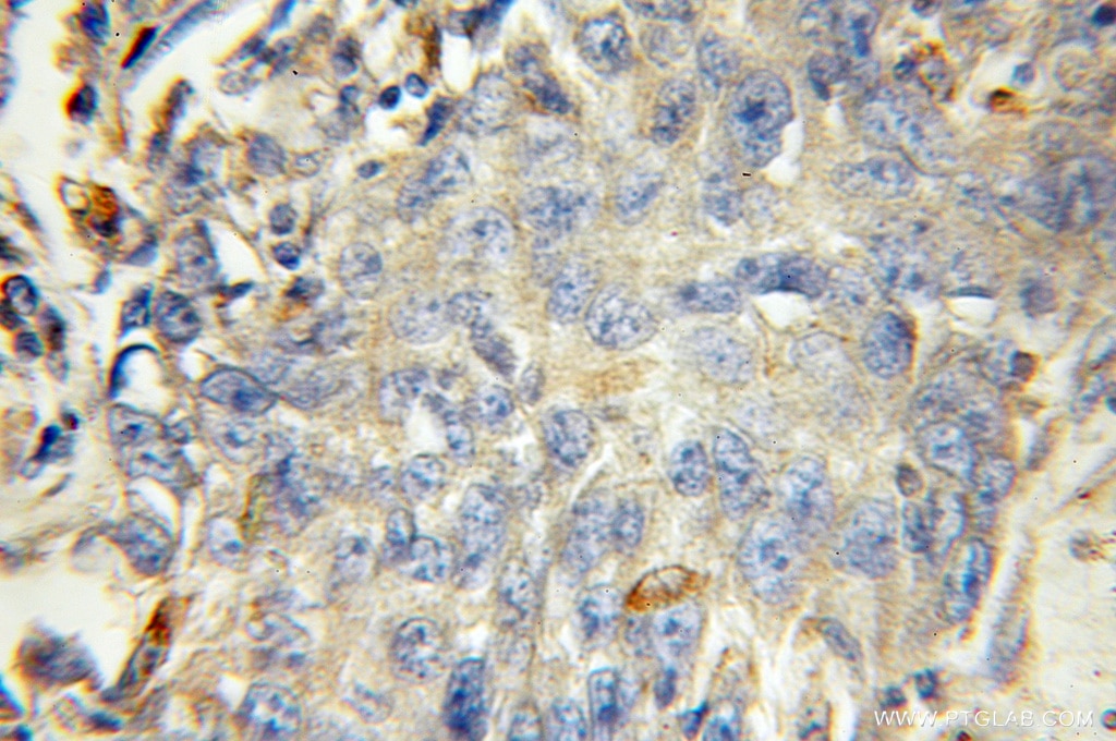 Immunohistochemistry (IHC) staining of human lung cancer tissue using HEXA Polyclonal antibody (11317-1-AP)