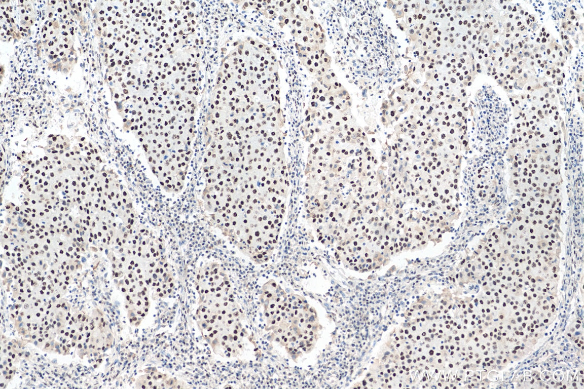 Immunohistochemistry (IHC) staining of human breast cancer tissue using HEXIM1 Polyclonal antibody (15676-1-AP)