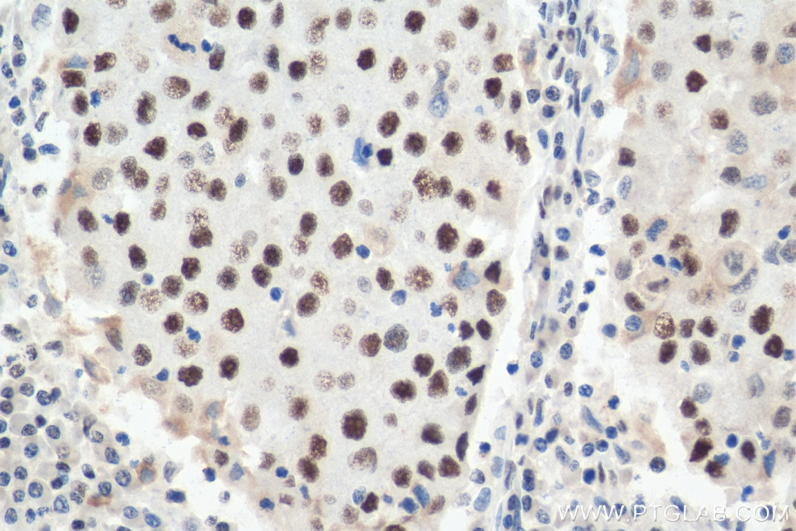 IHC staining of human breast cancer using 15676-1-AP